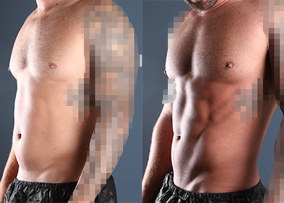 Before and after liposculpture in Raleigh NC with Dr. Jason Miller