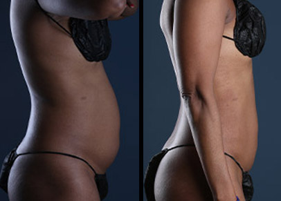 Before and after lipo treatment on the abdomen with Dr. Jason Miller