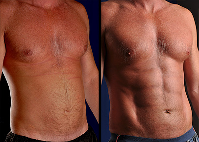 Male Abdomen Lipo