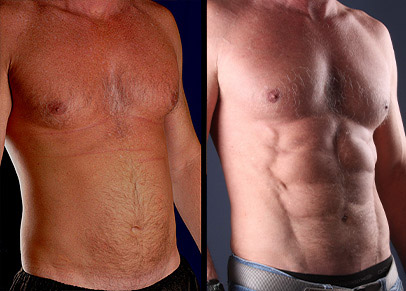 Real Before & After Image of a Liposculpture Treatment