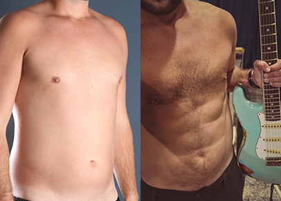 One of the best liposuction before and after photographs we have ever taken.
