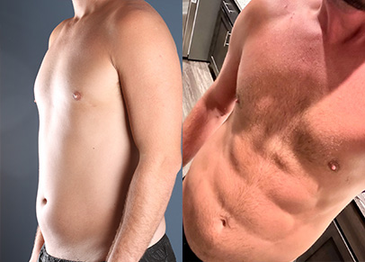 Before and after male abdomen lipo with Dr. Jason Miller