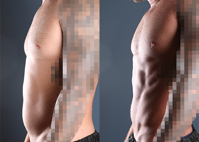 Great liposuction before and after shots of one male patient's abdomen.
