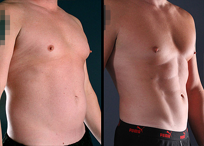 Male Abdomen Lipo