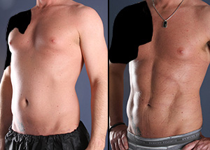 Outstanding results of one patient's liposuction seen before and after the procedure.
