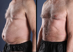 Before and after male abdomen lipo with Dr. Jason Miller