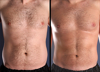 Immensily gratifying liposuction before and after result as shown by one of our most improved patients.
