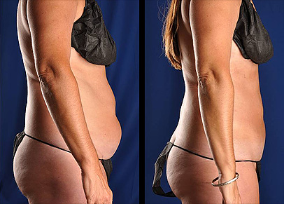 Two liposuction before and after photos that may just urge you to call today.
