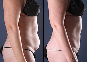 One female patient showcasing her amazing results via these liposuction before and after pictures.
