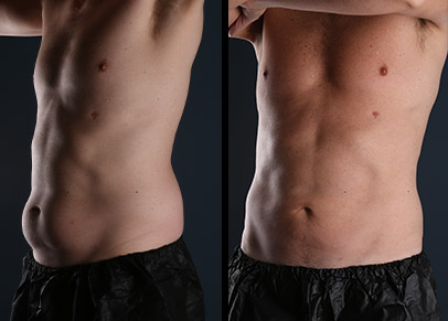 Two of our most popular liposuction before and after pictures.
