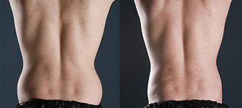A great liposuction before and after image shot not too long after this patient's initial surgery.

