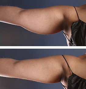Amazing arm liposuction before and after results shown by one of our favorite patients.
