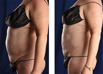 Some of the better liposuction before and after pictures we've ever taken.

