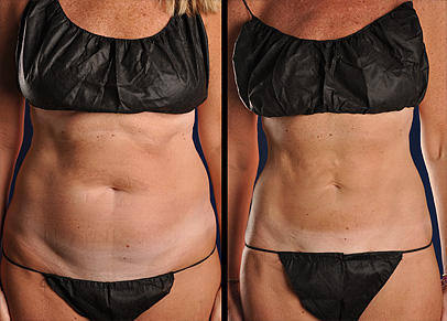 A picture depicting back liposuction before and after the procedure.
