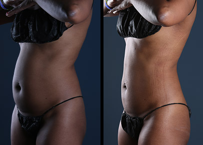 One of the best liposuction before and after photographs we have ever taken.