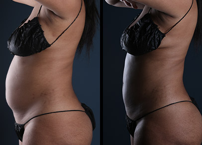 One of the best liposuction before and after photographs we have ever taken.