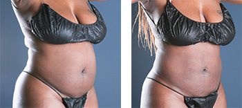 Great liposuction before and after shots of one male patient's abdomen.