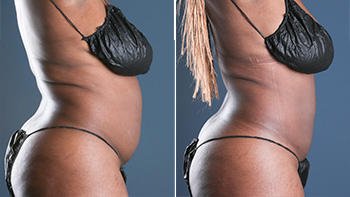 Great liposuction before and after shots of one male patient's abdomen.