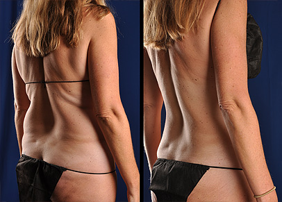 Liposuction of the 'love handles' or flanks